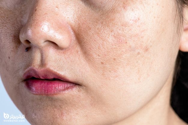 چه عواملی باعث ایجاد لکه های پوستی می شوند؟
