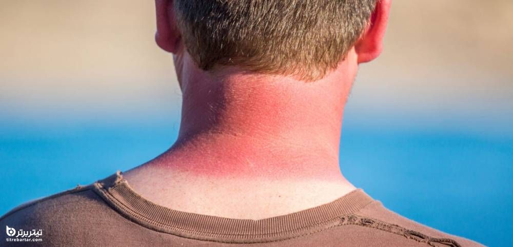 علائم آفتاب سوختگی روی پوست