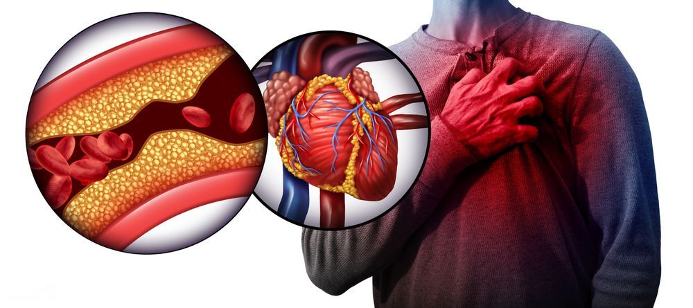 آیا درد قفسه سینه به دلیل سوزش سر دل یا حمله قلبی است؟