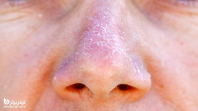 خشکی پوست اطراف بینی چقدر طول می کشد تا بهبود یابد؟