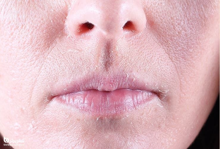 جلوگیری از خشکی پوست اطراف بینی
