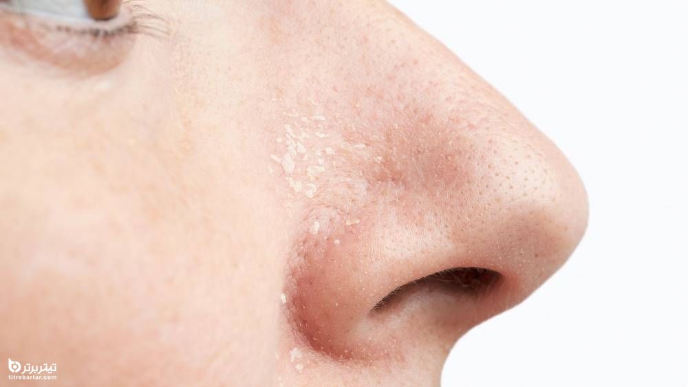 درمان خشکی پوست اطراف بینی