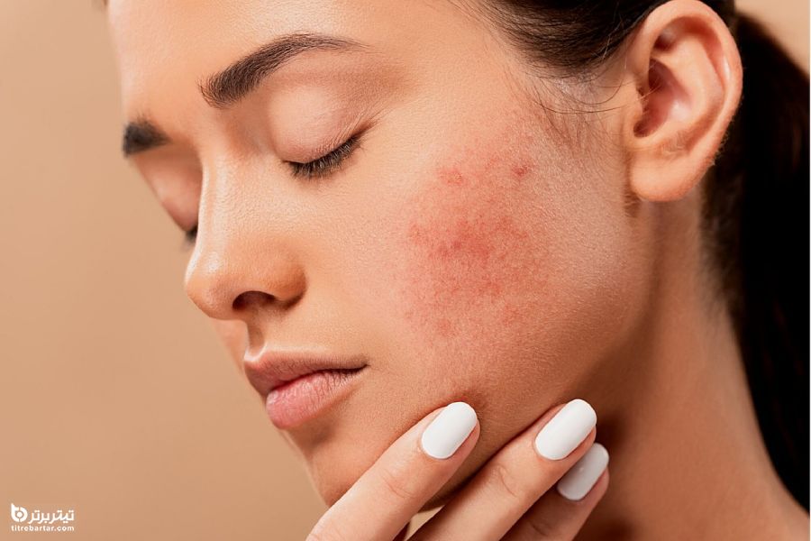چگونه التهاب پوست تشخیص داده می شود؟