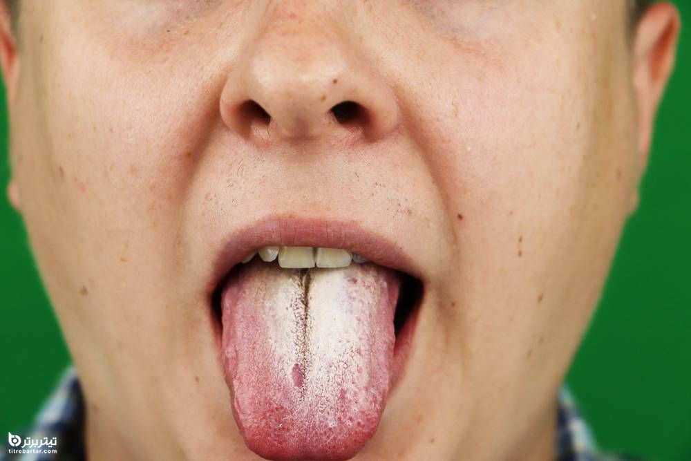 پیشگیری از برفک دهان