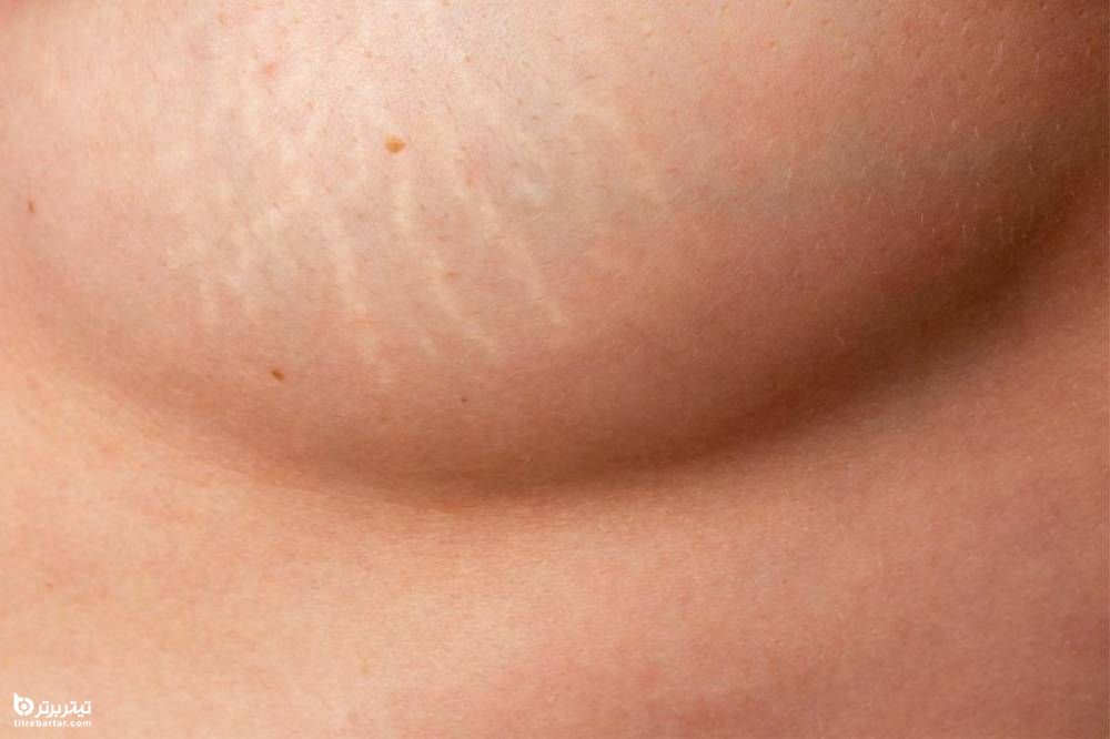 گزینه های درمان و پیشگیری برای ترک های پوستی روی سینه ها