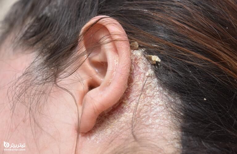 نکاتی برای جلوگیری از خشکی پوست در گوش