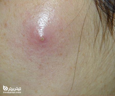 عوارض آبسه پوستی