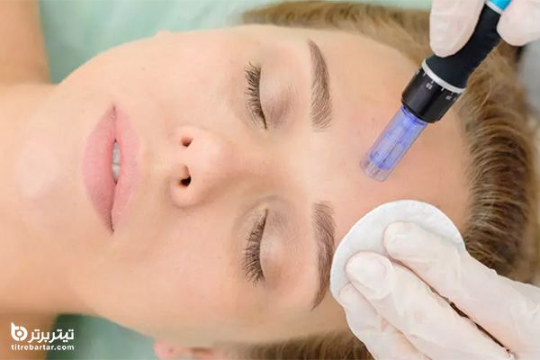 آیا میکرونیدلینگ عوارض جانبی دارد؟