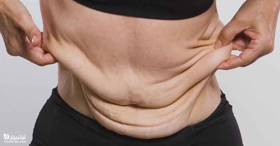 نکاتی برای جلوگیری از ایجاد اسکار پس از جراحی لیپوساکشن