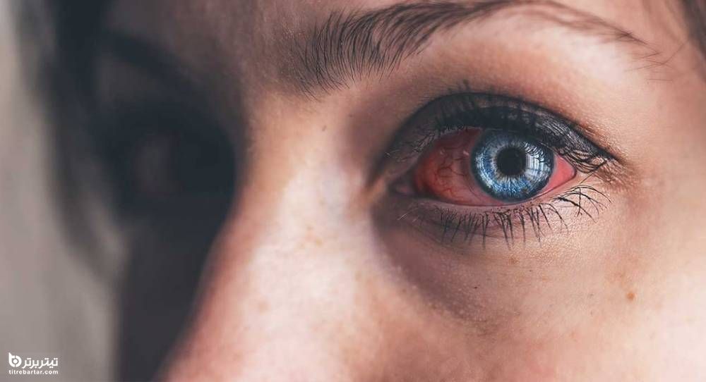 درمان خانگی موثر برای عفونت چشم