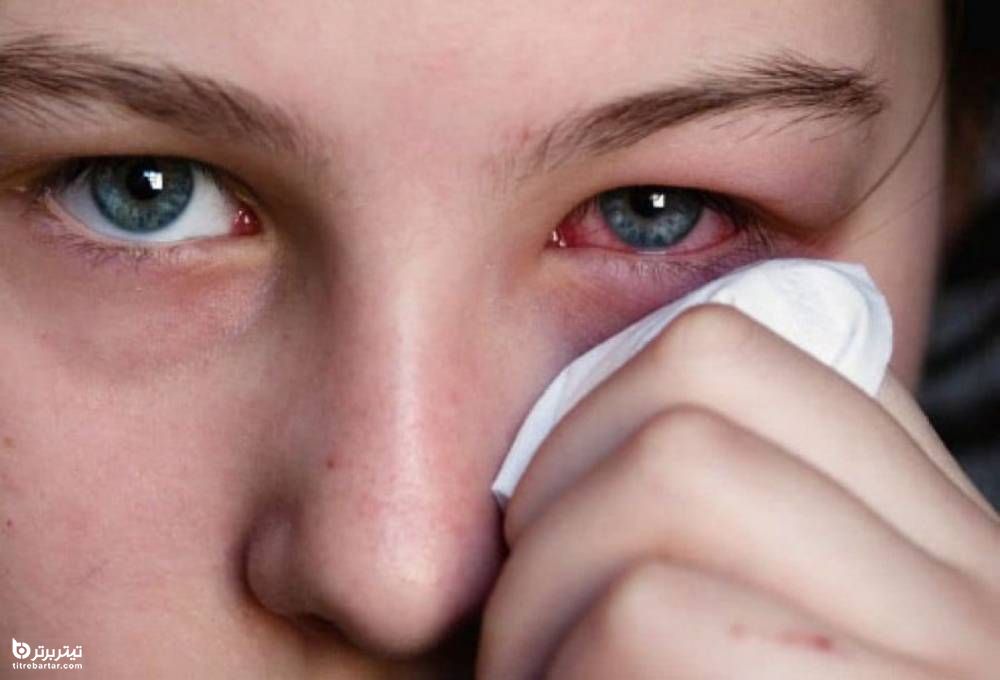 درمان خانگی موثر برای عفونت چشم
