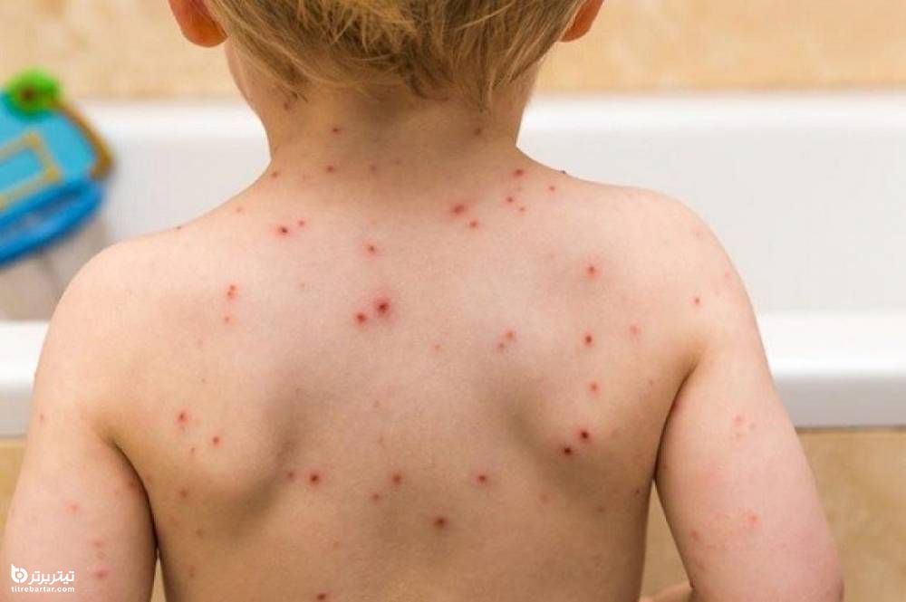 واکسن سرخک در چند ماهگی زده می شود؟