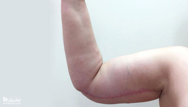 جراحی لیفت بازو و براکیوپلاستی چیست؟ 