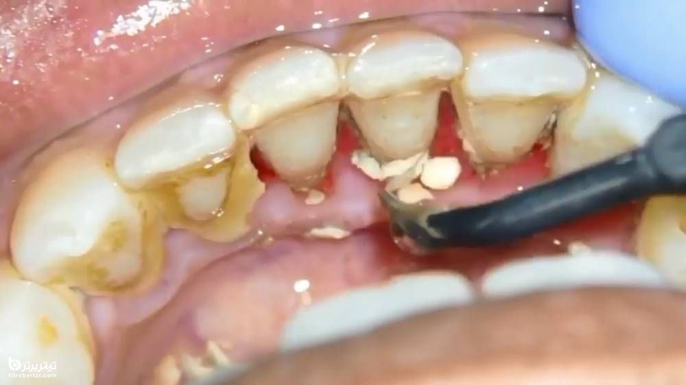 جلوگیری از ایجاد جرم و پلاک دندان
