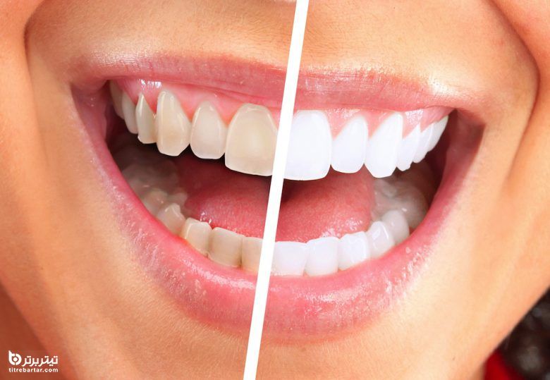 جرم دندان چیست و چطور تشکیل می‌شود؟