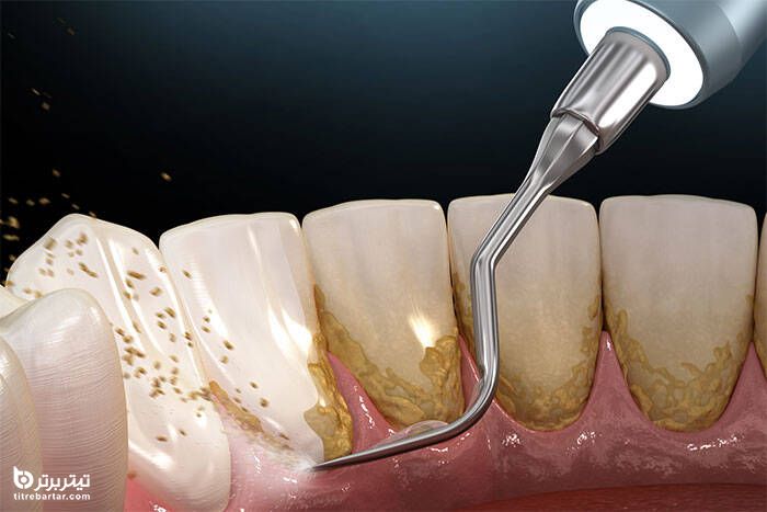سایر روش‌های جرم گیری دندان