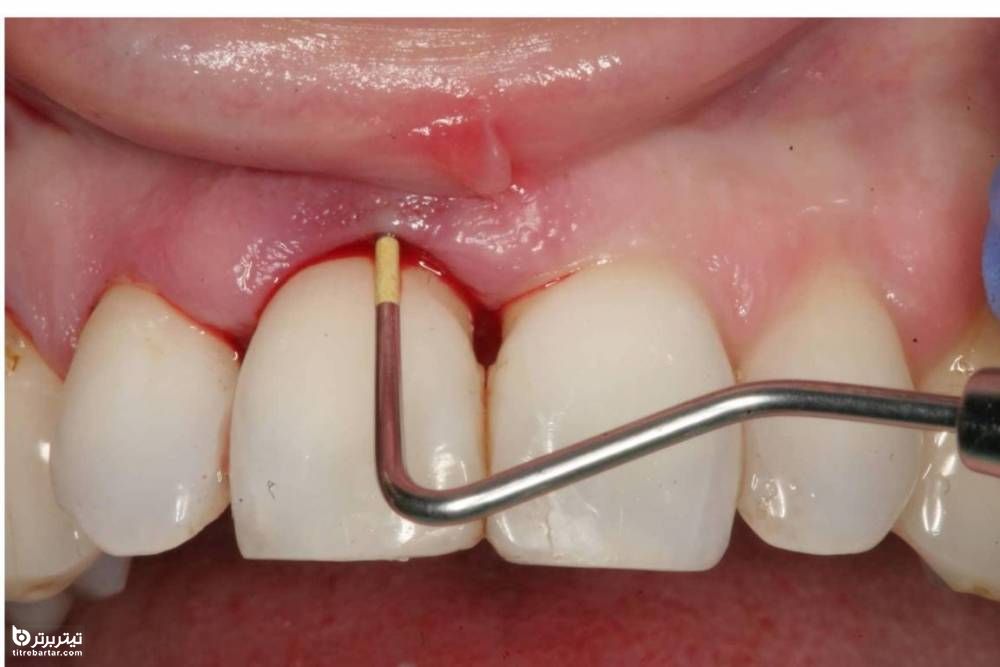 روش های از بین بردن جرم دندان