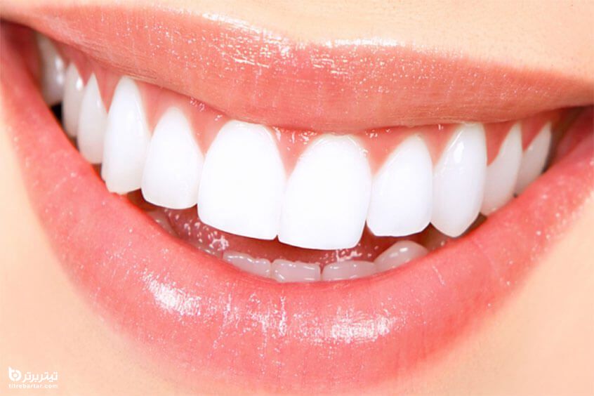 طول عمر دندان لمینت شده