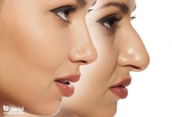 چگونه می توان از وارد شدن ضربه به بینی بعد عمل زیبایی پیشگیری کرد؟