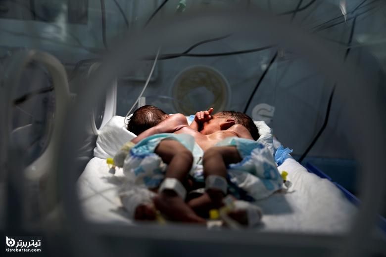 تولد دوقلوهای به هم چسبیده در یمن 