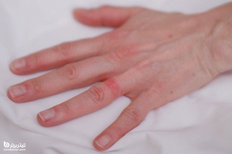 حساسیت پوستی چیست؟