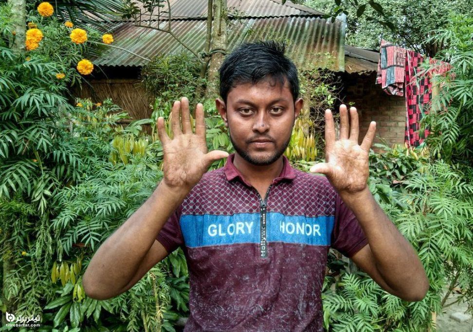 پسر ۲۲ ساله بنگلادشی فاقد اثر انگشت‌ به دلیل خاصیت ژنتیکی نادری