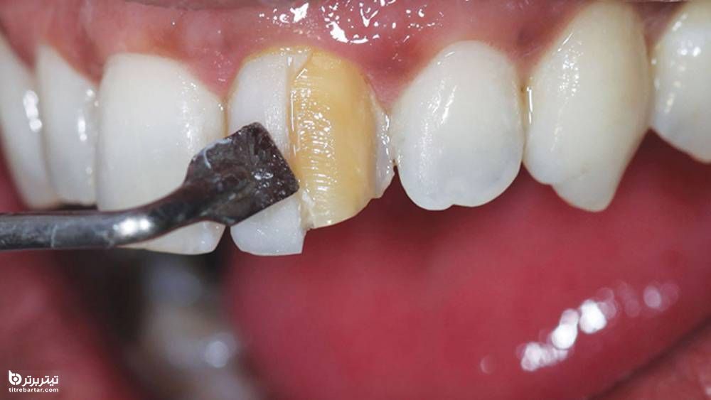 چه کسانی مناسب کامپوزیت دندان هستند؟