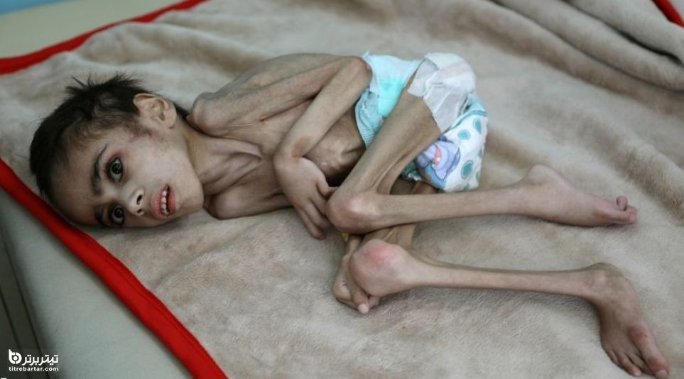سوءتغذیه وحشتناک پسر ۷ ساله یمنی دچار فلج مغزی 