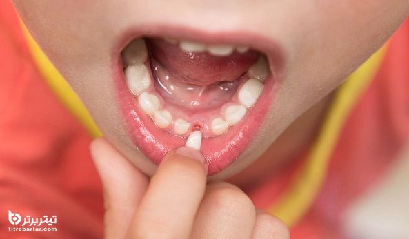 رشد دندان دائمی کودک