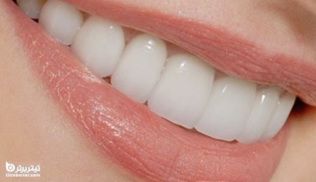 مهم ترین تاثیر فلوراید بر دندان ها