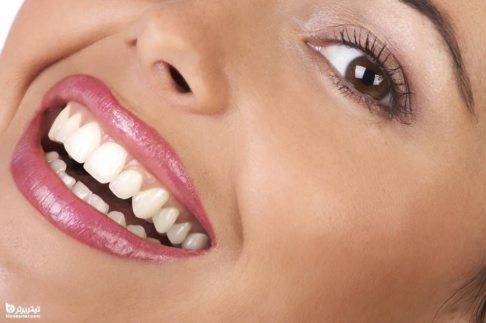 مهم ترین دلایل سفید شدن دندان ها