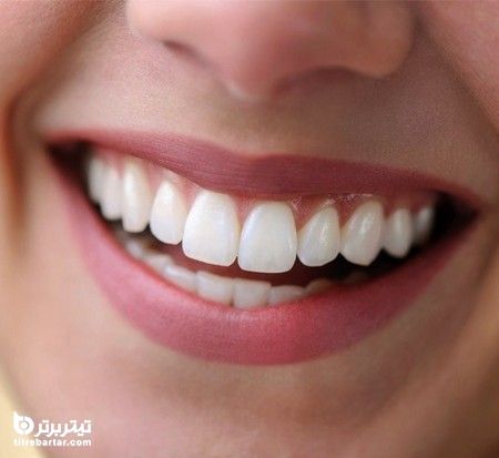 جوش شیرین به عنوان سفید کننده دندان