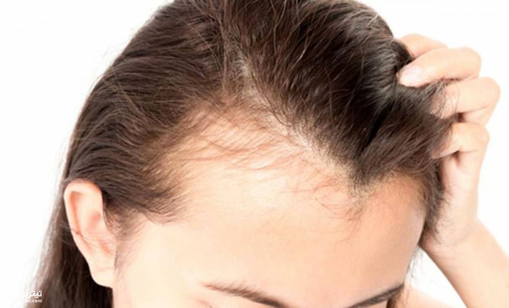 مهم ترین راهکارهای جلوگیری از ریزش مو