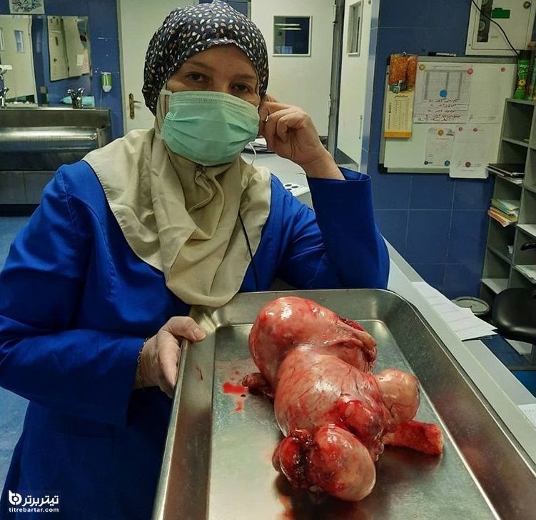  برآمدگی شکم زن تهرانی در بیمارستان یاس