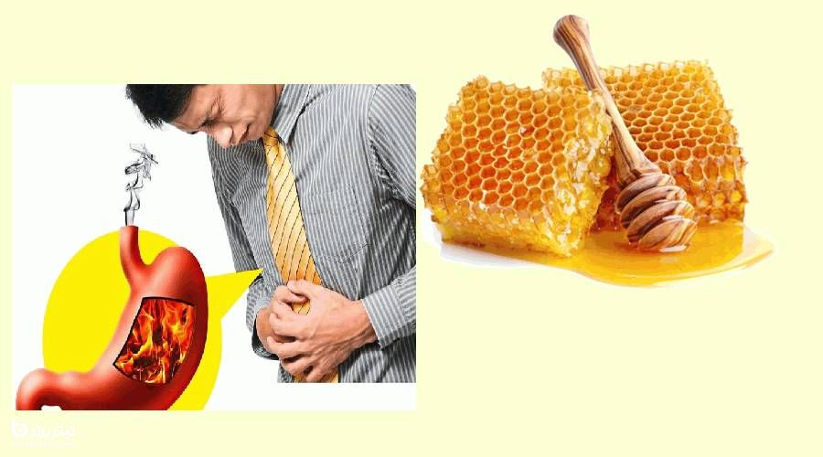 درمان رفلاکس معده با عسل