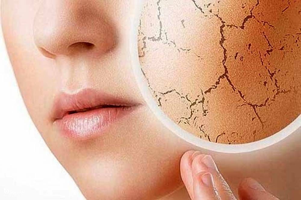  خشکی پوست دقیقا چیست؟