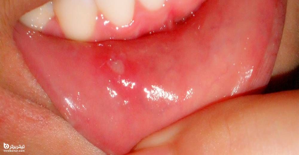 آفت دهان چیست و چه علائمی دارد؟