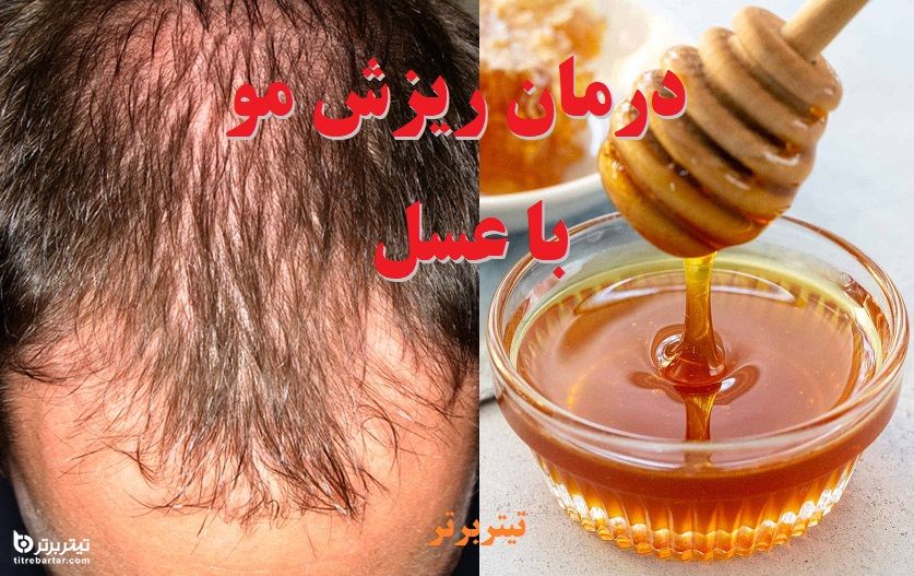 تاثیر عسل در درمان ریزش مو