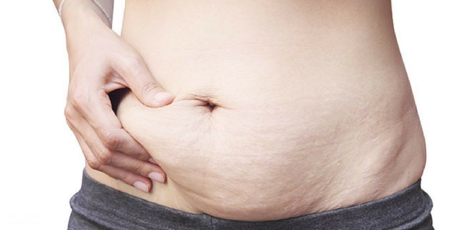 چه کسانی می‌توانند از جراحی زیبایی شکم یا ابدومینوپلاستی استفاده کنند؟