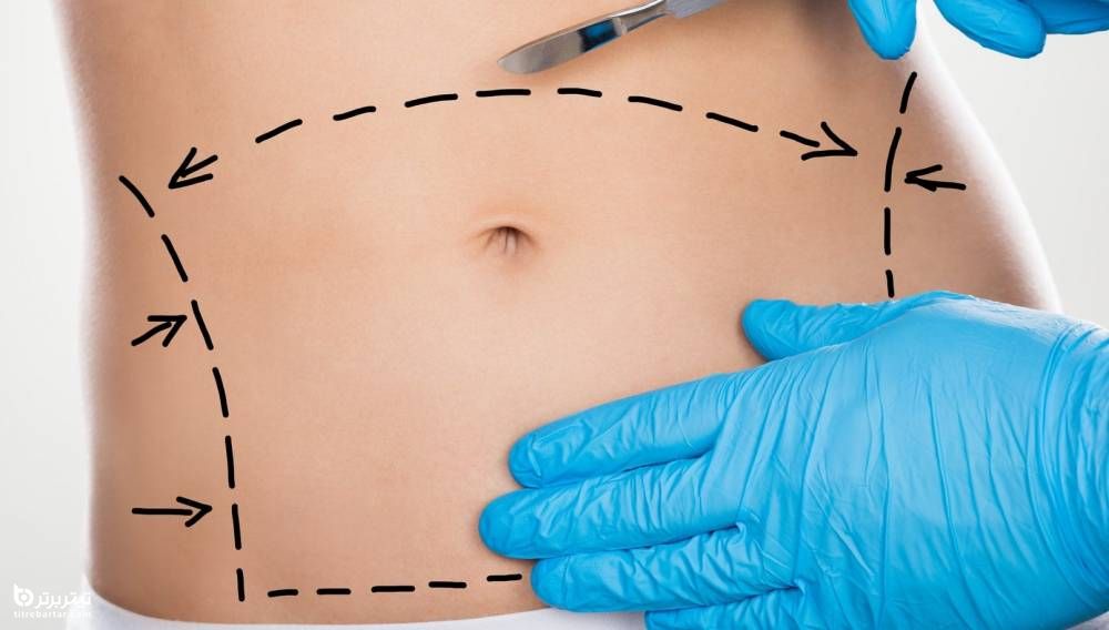 جراحی شکم (ابدومینوپلاستی) چگونه انجام می شود؟