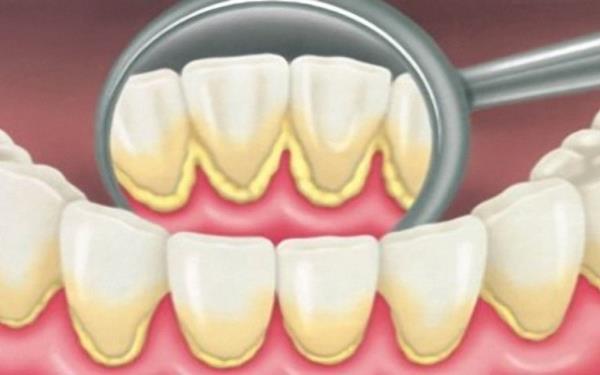 درمانهای خانگی برای رهایی از جرم دندان