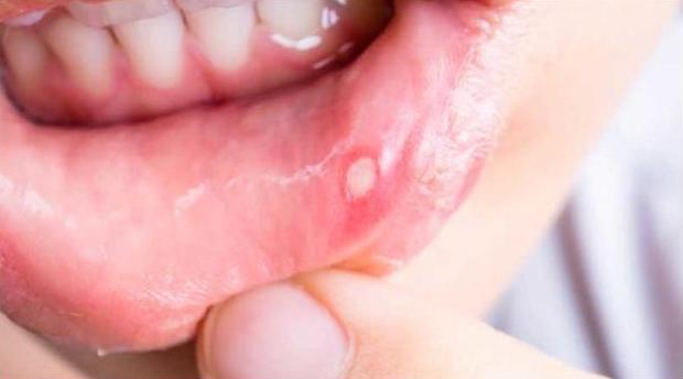 با 15 درمان خانگی آفت دهان بیشتر آشنا شوید