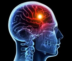 علائم سکته مغزی را بهتر بشناسیم
