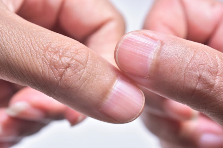 راه درمان شیارها و لکه های روی ناخن