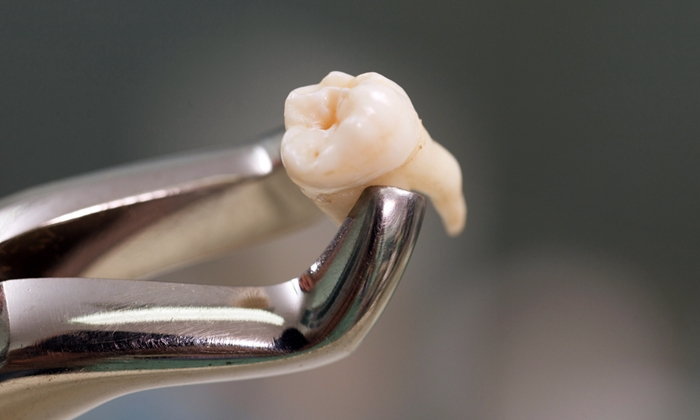دندان عقل مفید است یا مضر؟(همه چیز در مورد دندان عقل)