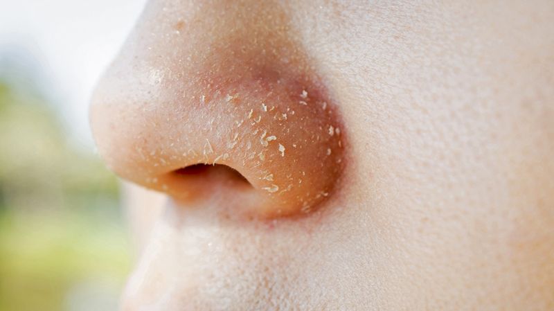 چگونه پوست خشک و پوسته پوسته اطراف بینی را درمان کنیم
