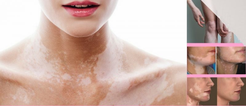 چه چیزی باعث نقاط سفید بر روی پوست شما می شود؟