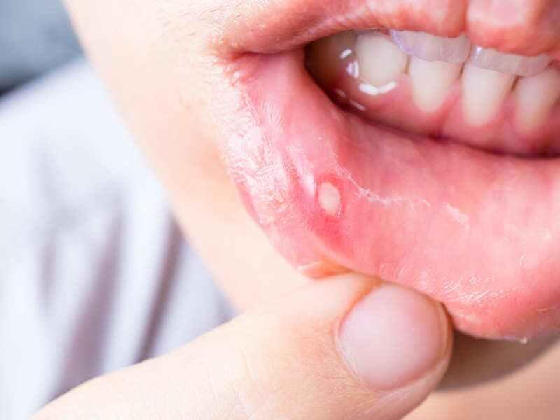 آفت دهان: بهترین درمان خانگی برای زخم دهان