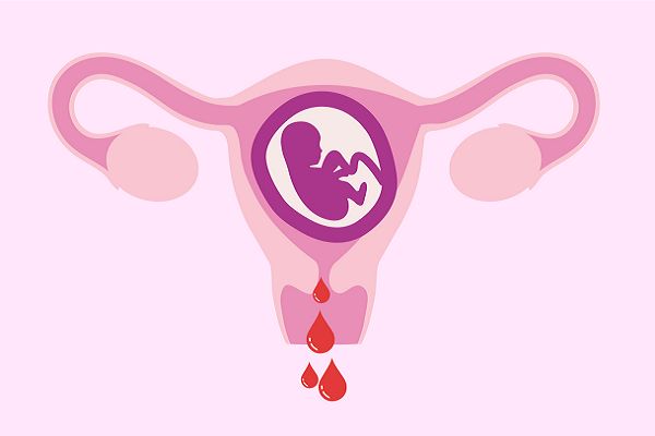 خونریزی در دوران بارداری به چه معناست؟