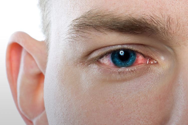 چگونه عفونت چشم را در خانه درمان کنیم؟